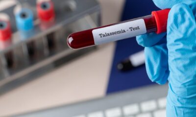 talassemia-quando-uma-anemia-v