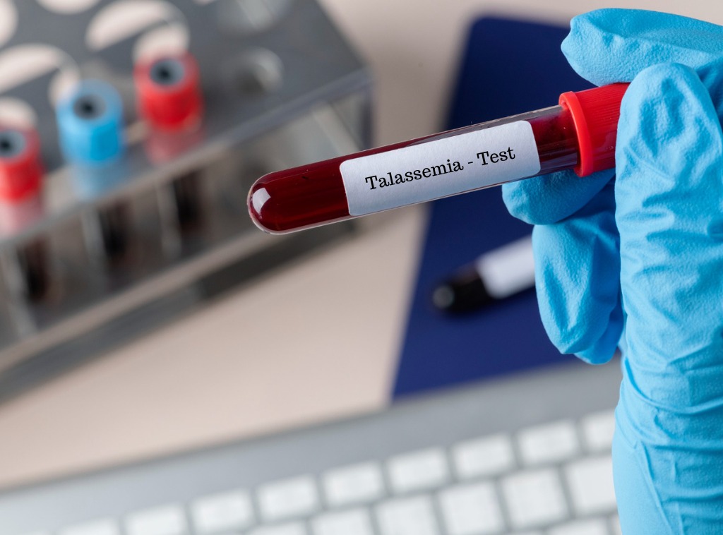talassemia-quando-uma-anemia-v