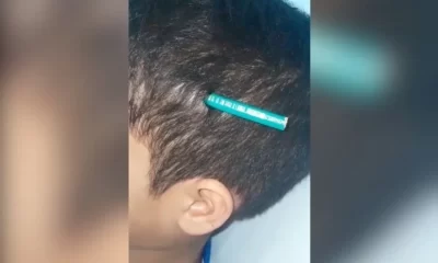 crianca-de-9-anos-tem-lapis-cravado-na-cabeça