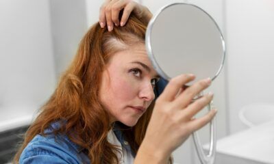 alopecia-saude-canal92am