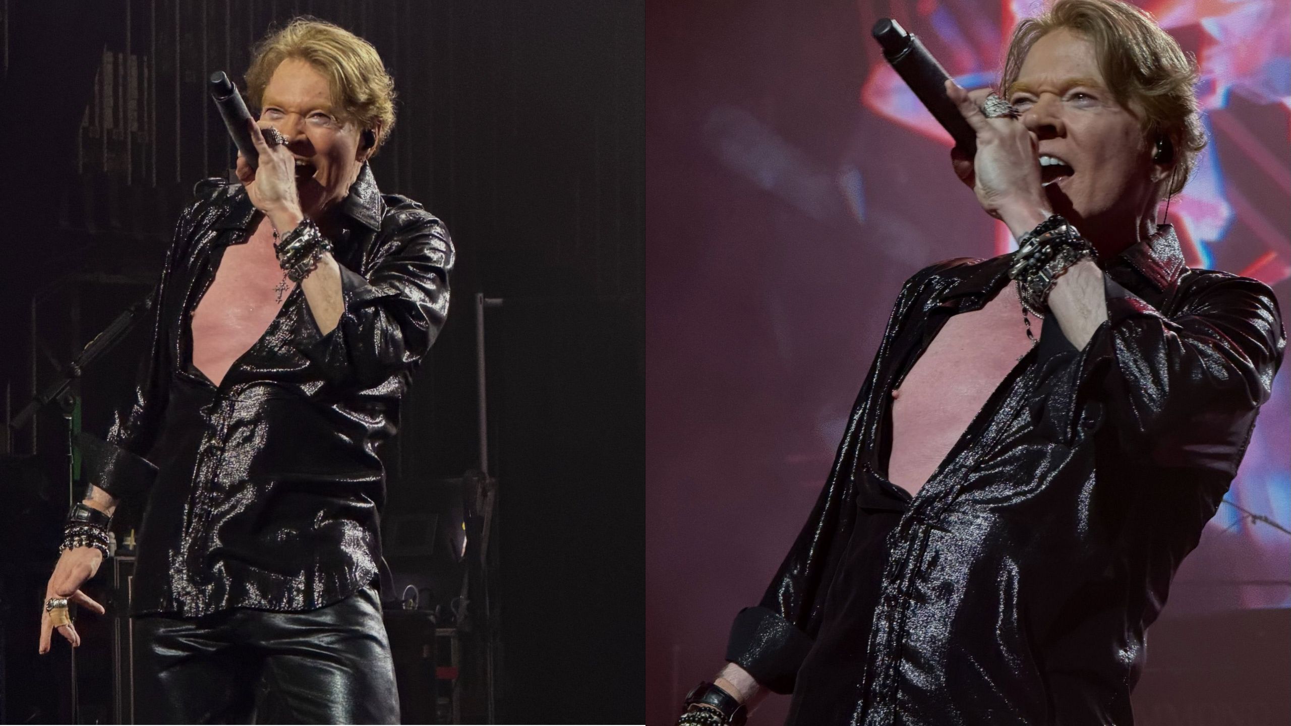 axl-rose-cirurgia-mandibula-canal92am